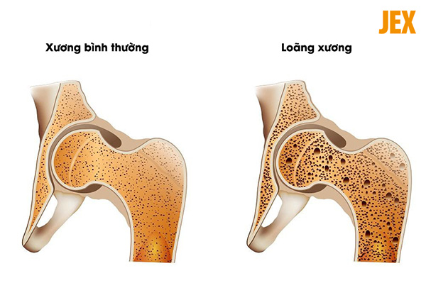 Người bệnh loãng xương nên uống sữa gì?