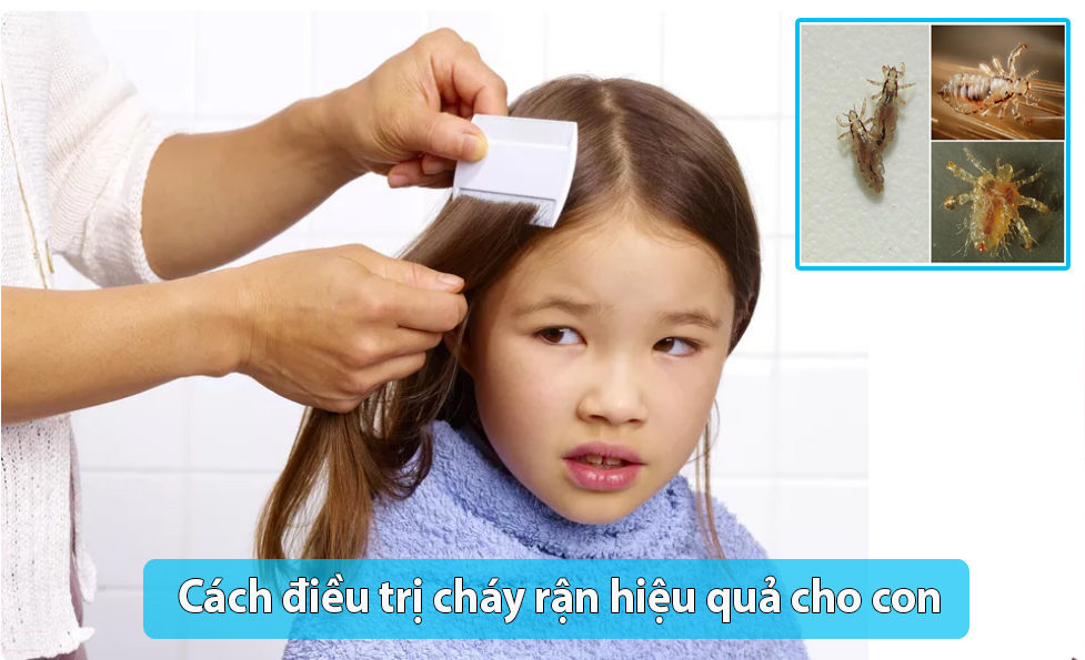 NGỨA DA ĐẦU, COI CHỪNG BỊ CHẤY (CHÍ) RẬN