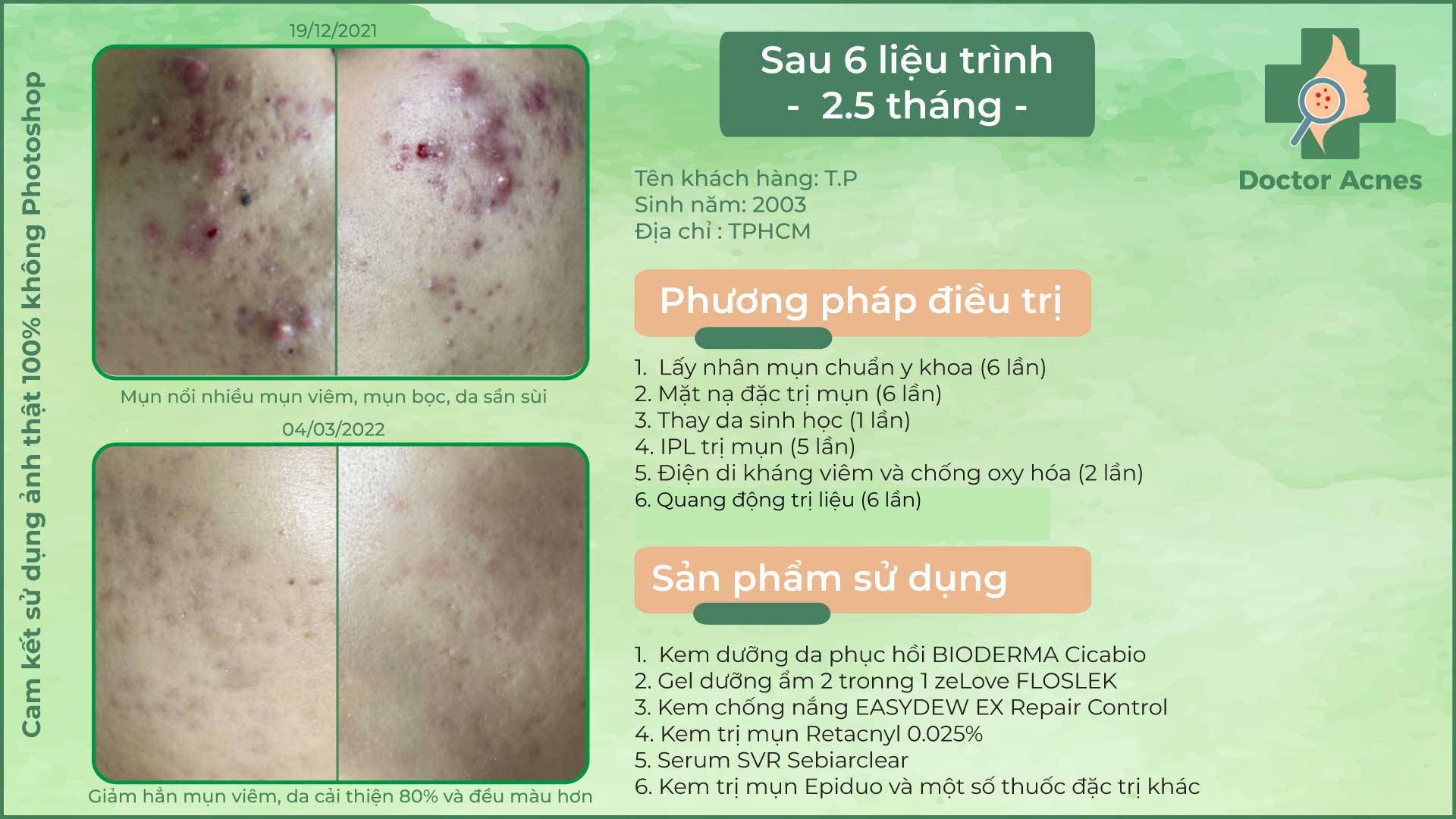 Quy trình các bước skincare cho da mụn chuẩn y khoa