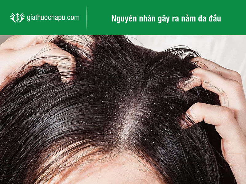 Top 5 thuốc trị nấm da đầu hiệu quả