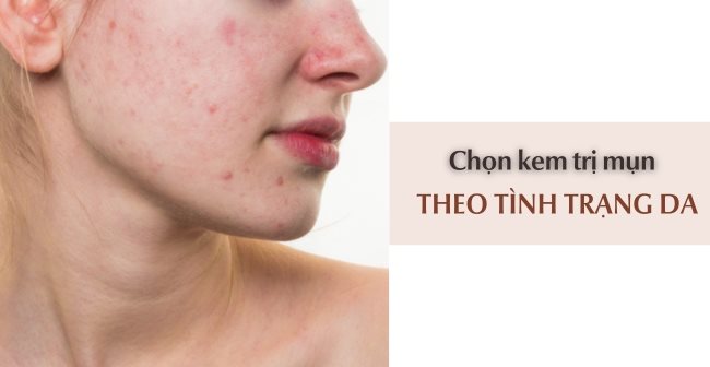 Top 3 kem trị mụn cho da dầu hiệu quả tốt nhất hiện nay