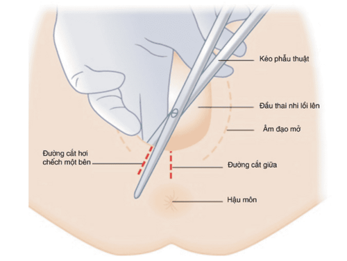 Vết khâu sau sinh bị hở dễ nhiễm trùng