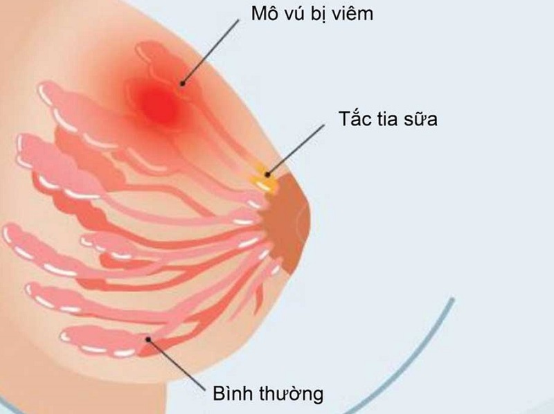 Hướng dẫn tự xoa bóp chữa tắc tia sữa ngay tại nhà đơn giản mà hiệu quả