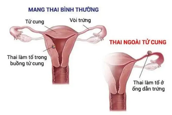 Phụ nữ đau bụng dưới và đau lưng có phải mang thai không?