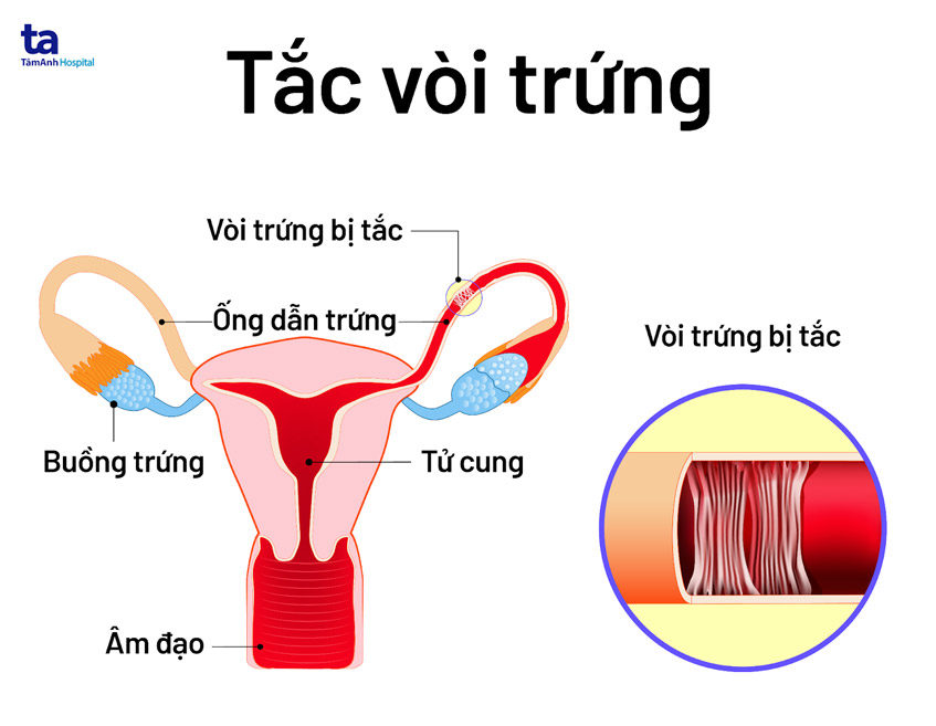 Hiếm muộn là gì? Nguyên nhân, dấu hiệu, chẩn đoán, phòng ngừa