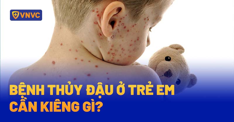 Bệnh thủy đậu ở trẻ em cần kiêng gì? Ăn gì nhanh khỏi?