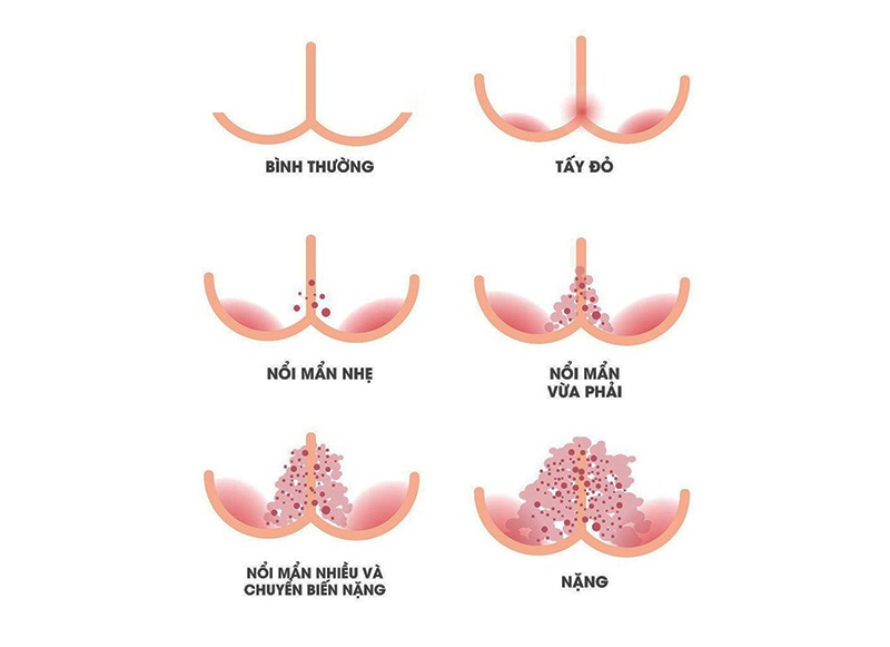 Hăm da là gì? Cách trị hăm da cho trẻ