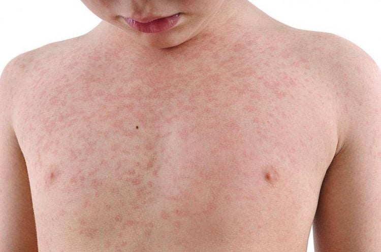 Bệnh rubella: Nguyên nhân, triệu chứng, biến chứng và cách đề phòng