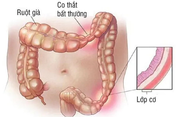 Phụ nữ đau bụng dưới và đau lưng có phải mang thai không?