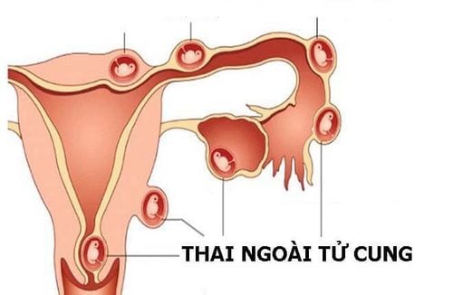 Chảy máu trong nửa đầu thời kỳ mang thai