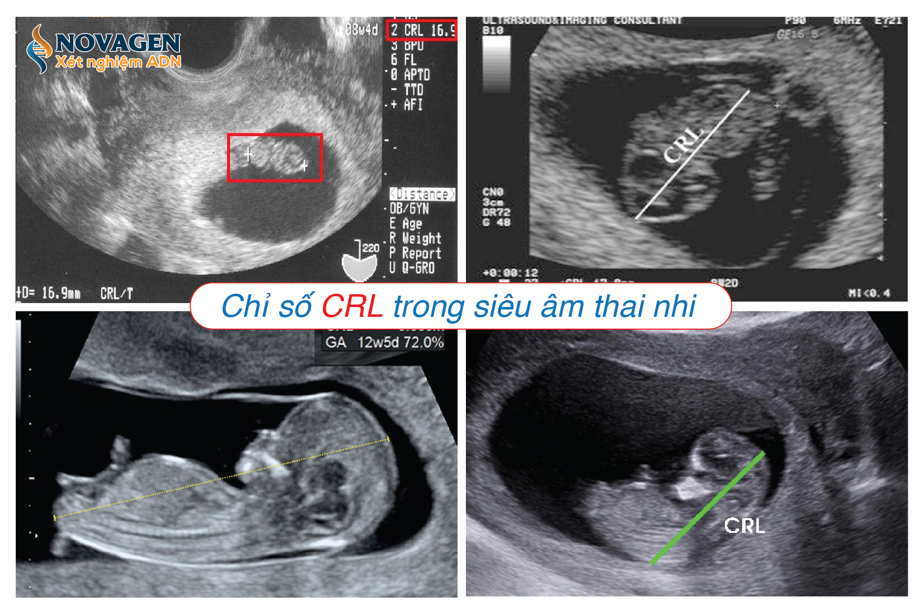 Chỉ Số CRL Trong Siêu Âm Thai Là Gì?