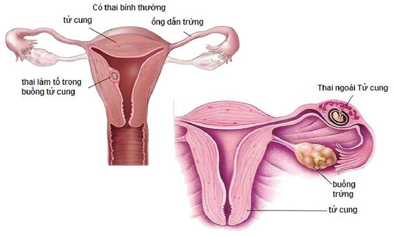 Siêu âm 5 tuần chưa có tim thai liệu bé có đang khỏe mạnh