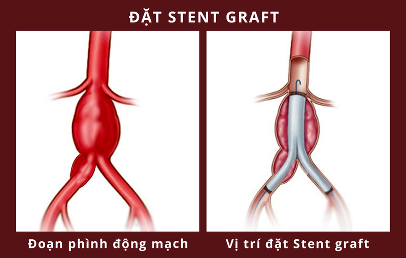 Bụng có nhịp đập có phải hiện tượng bất thường?