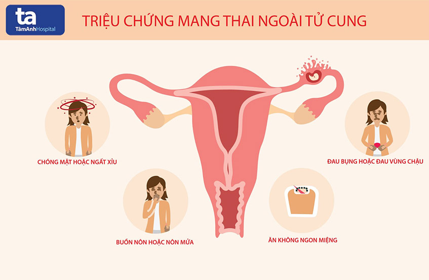 Mấy tuần thì biết thai ngoài tử cung? Siêu âm có thấy không?