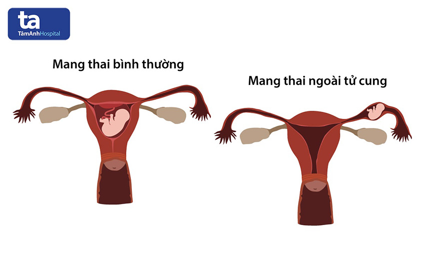 Mấy tuần thì biết thai ngoài tử cung? Siêu âm có thấy không?