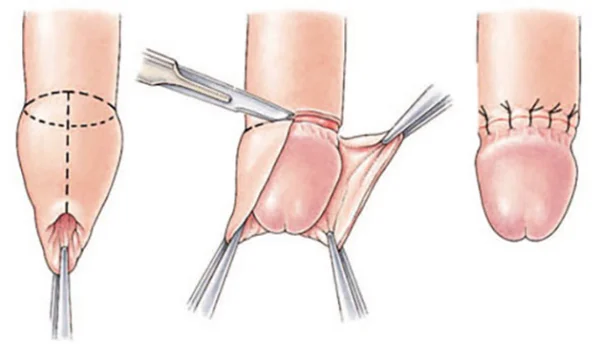 Viêm bao quy đầu ở trẻ em: Nguyên nhân và cách khắc phục