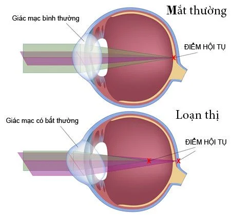 Loạn thị nguyên nhân triệu chứng và cách điều trị