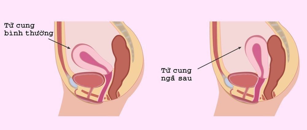 Tử cung ngả sau: Những điều cần biết