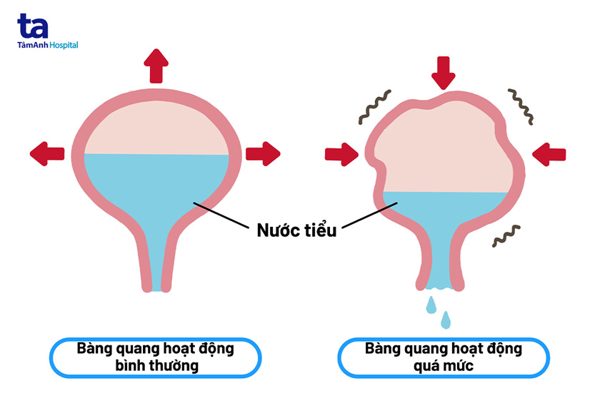 Són tiểu khi mang thai: Nguyên nhân, biểu hiện và cách điều trị