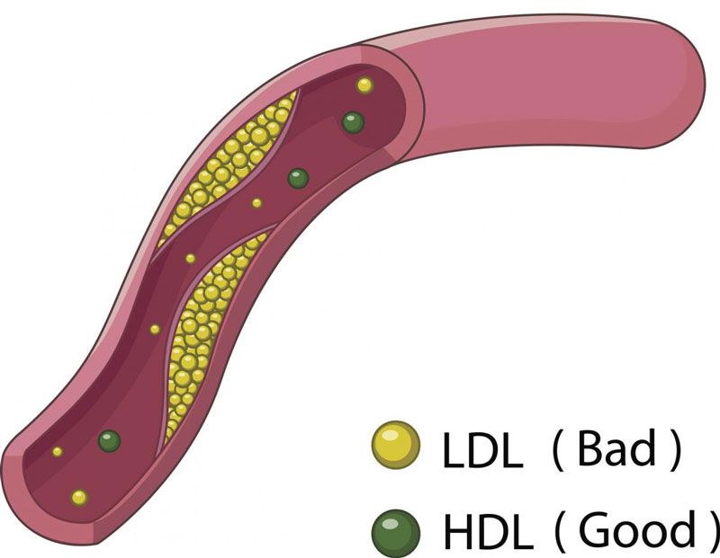 Xét nghiệm LDL là gì? Chỉ số LDL như thế nào an toàn?