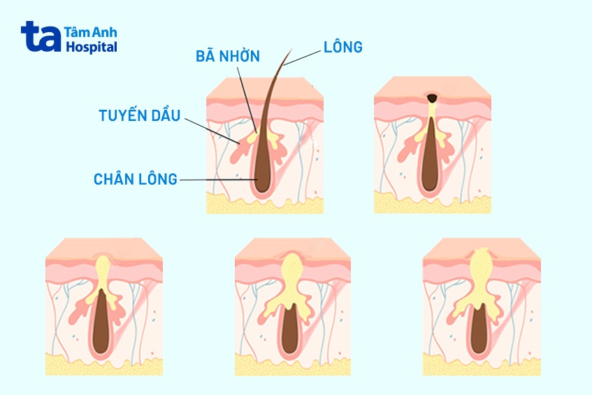 20+ cách trị mụn bọc tại nhà hiệu quả ít tiền ai cũng làm được