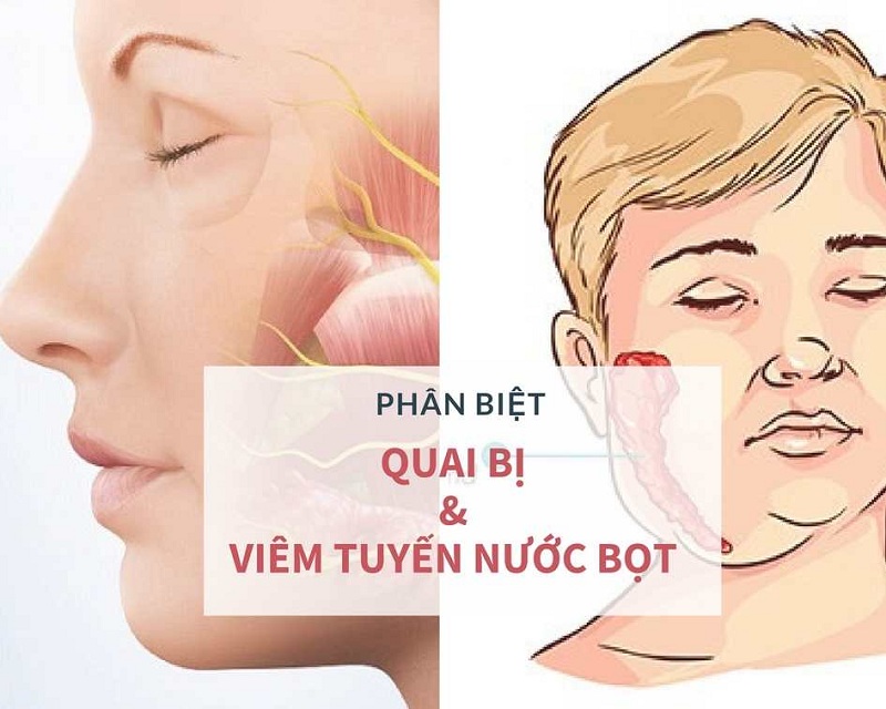 Chỉ điểm những triệu chứng quai bị dễ nhận diện