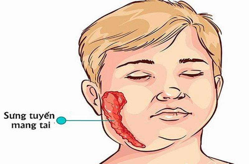 Chỉ điểm những triệu chứng quai bị dễ nhận diện