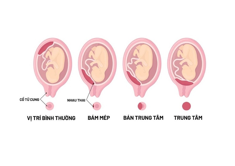 Gợi ý mẹ bầu tư thế nằm khi bị nhau tiền đạo