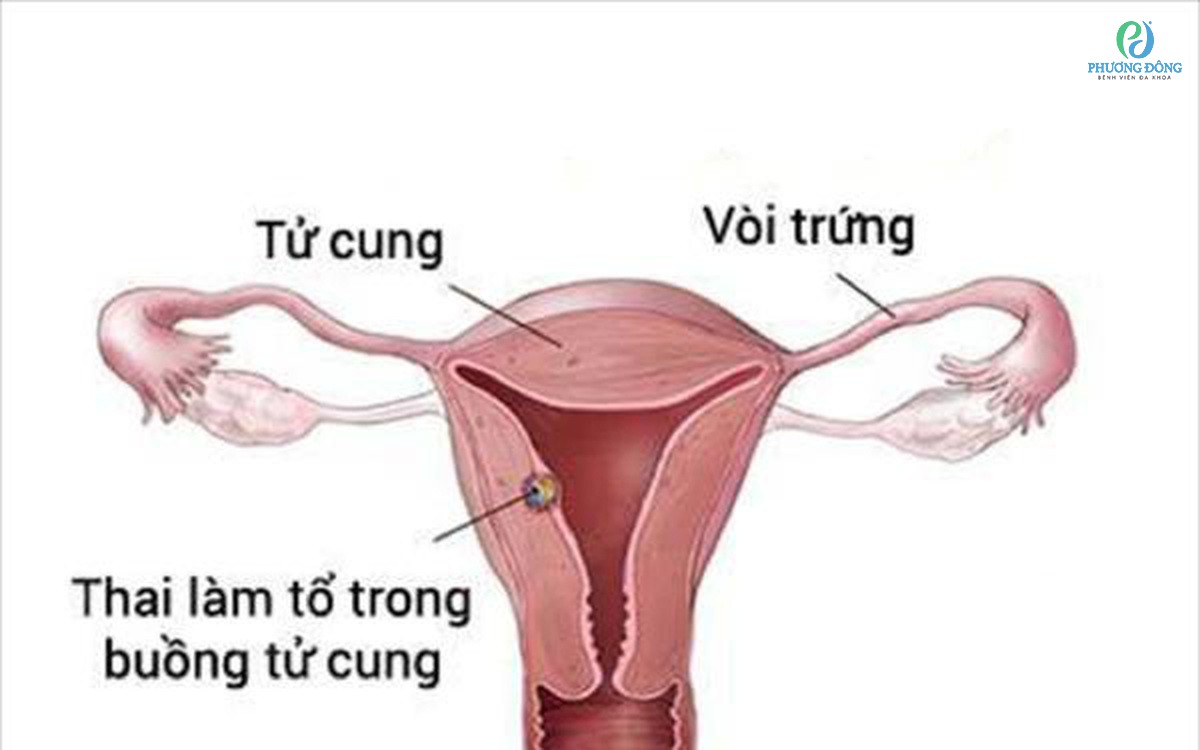 Nguyên nhân thai vào tử cung chậm và dấu hiệu thai đã vào tử cung