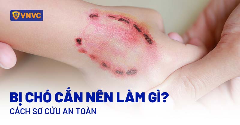 Bị chó cắn nên làm gì? 6 cách xử lý và sơ cứu an toàn, bài bản