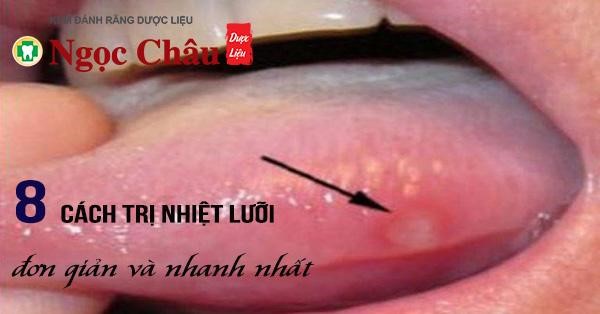 8 Cách Trị Nhiệt Lưỡi Đơn Giản Và Nhanh Nhất