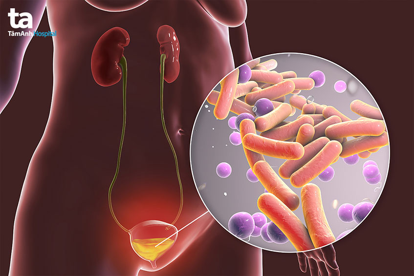 Viêm đường tiết niệu: Nguyên nhân, triệu chứng, chẩn đoán, điều trị