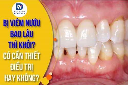 Sưng nướu răng có tự hết không? Bao lâu thì khỏi?