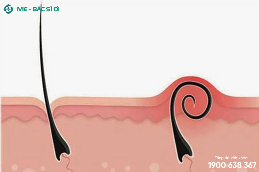 Lông mọc ngược có sao không? 3 Cách xử lý