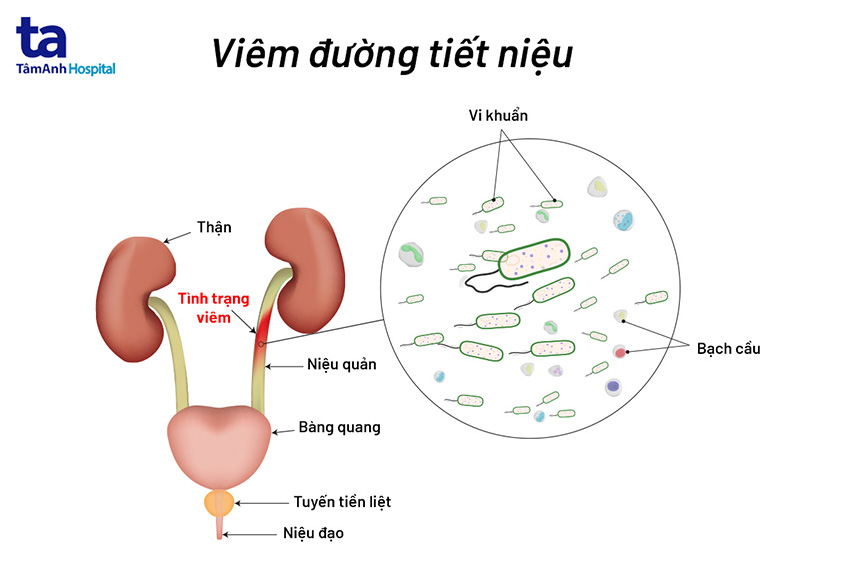 Viêm đường tiết niệu: Nguyên nhân, triệu chứng, chẩn đoán, điều trị