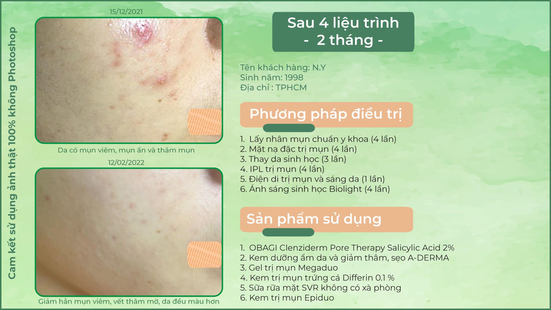 Bao lâu thì peel da 1 lần để không gây hại cho da