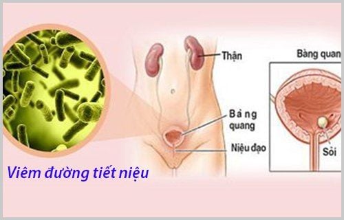 Viêm đường tiết niệu là bệnh gì và có nguy hiểm không?