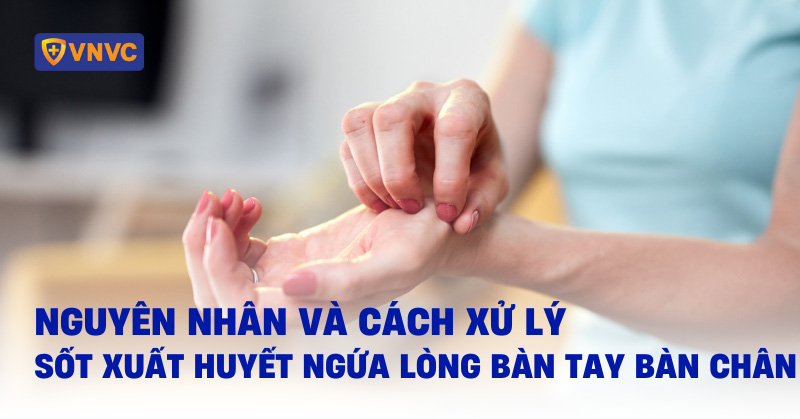 Sốt xuất huyết ngứa lòng bàn tay bàn chân: Nguyên nhân và cách xử lý