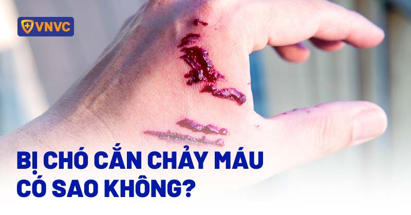 Bị chó cắn chảy máu có sao không? Phải làm gì để phòng dại?