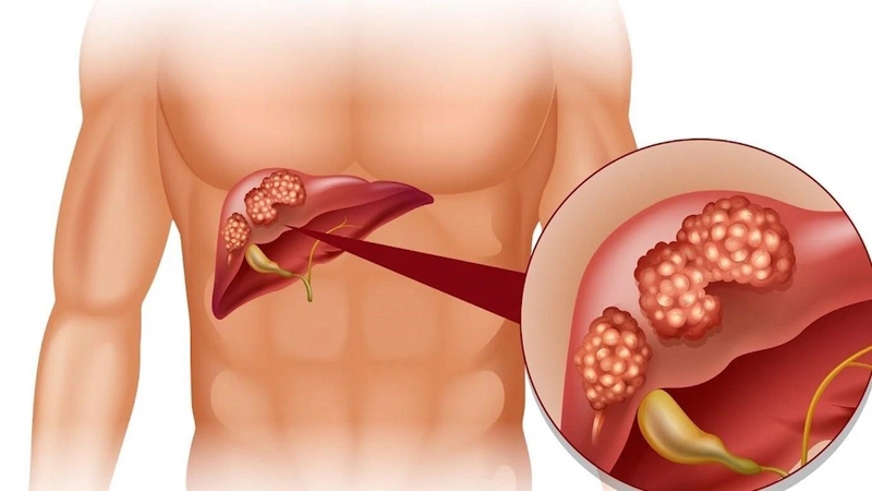 Ăn gì để thải độc gan và thận? Gợi ý thực đơn giúp thải độc gan