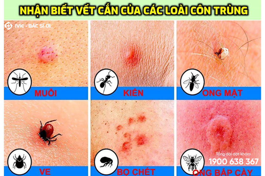 6 cách phân biệt và xử lý vết côn trùng cắn sưng đỏ ngứa tại nhà