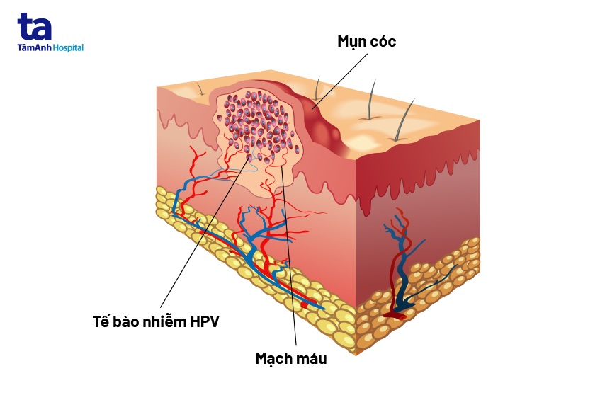 13 cách trị mụn cóc hiệu quả, nhanh chóng, hết gốc rễ và an toàn