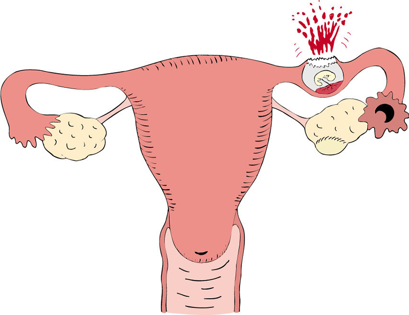 Đau bụng dưới ở phụ nữ là dấu hiệu của bệnh gì và có nguy hiểm không?