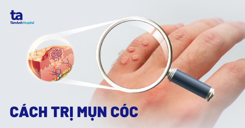 13 cách trị mụn cóc hiệu quả, nhanh chóng, hết gốc rễ và an toàn