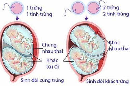 Sinh đôi khác trứng là gì?