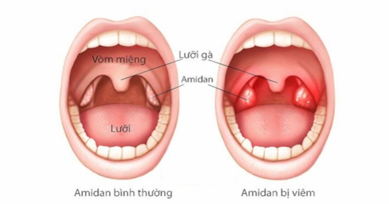 Không ho nhưng có đờm ở cổ họng do nguyên nhân nào?