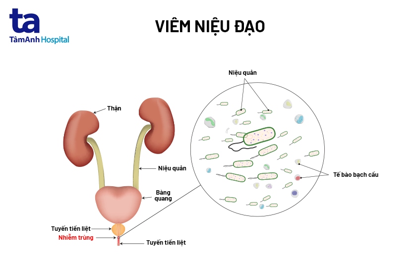 Viêm niệu đạo: Nguyên nhân, triệu chứng và điều trị