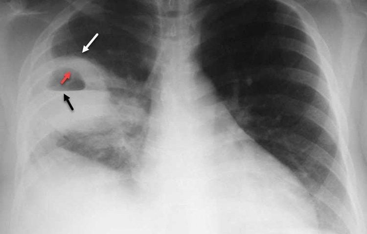 Tìm hiểu về virus rsv (virus hợp bào hô hấp) gây viêm phổi ở trẻ