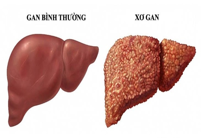 Da vàng là thiếu chất gì và cách khắc phục như thế nào?