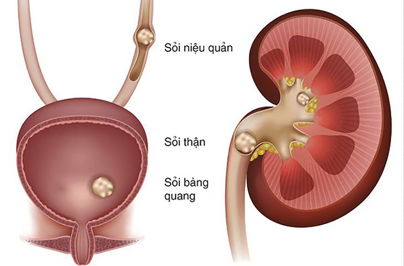 Đau bụng dưới ở nữ là biểu hiện của bệnh lý nào?